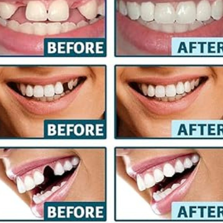 Carillas Dentales Sonrisa Perfecta Express – Transformación en Minutos + Envio Gratis + ¡Oferta imperdible! Solo por tiempo limitado 🔥⚡
